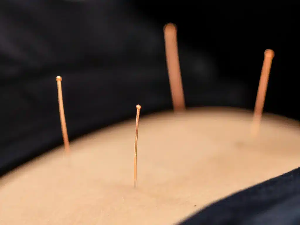 acupuncture orillia